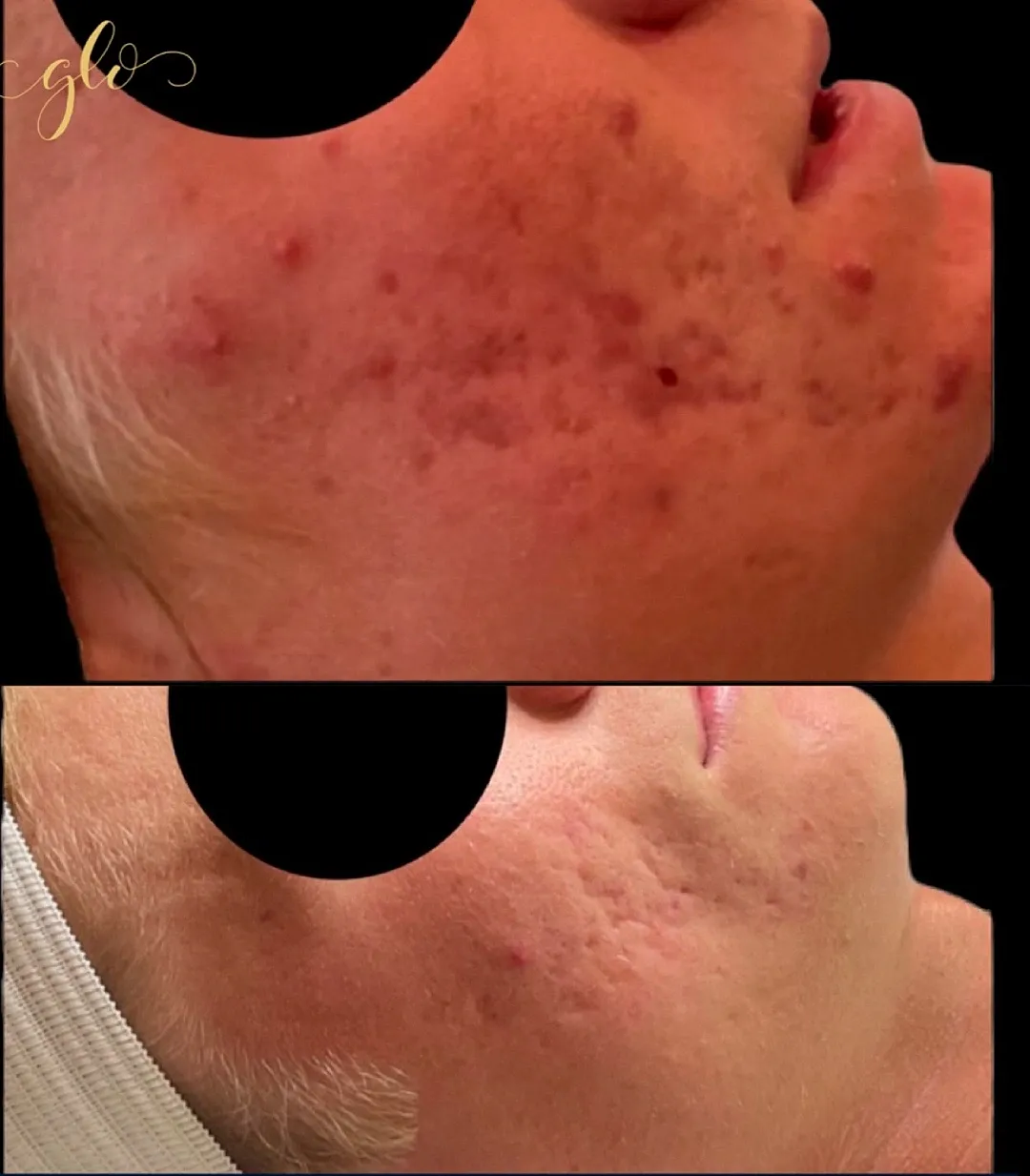 Before and after acne treatment comparison.