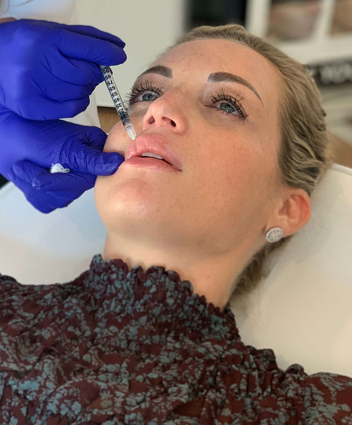 Woman receiving lip injection treatment in clinic.