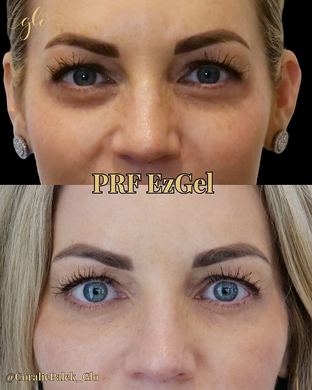 PRF EzGel Gallery Before & After