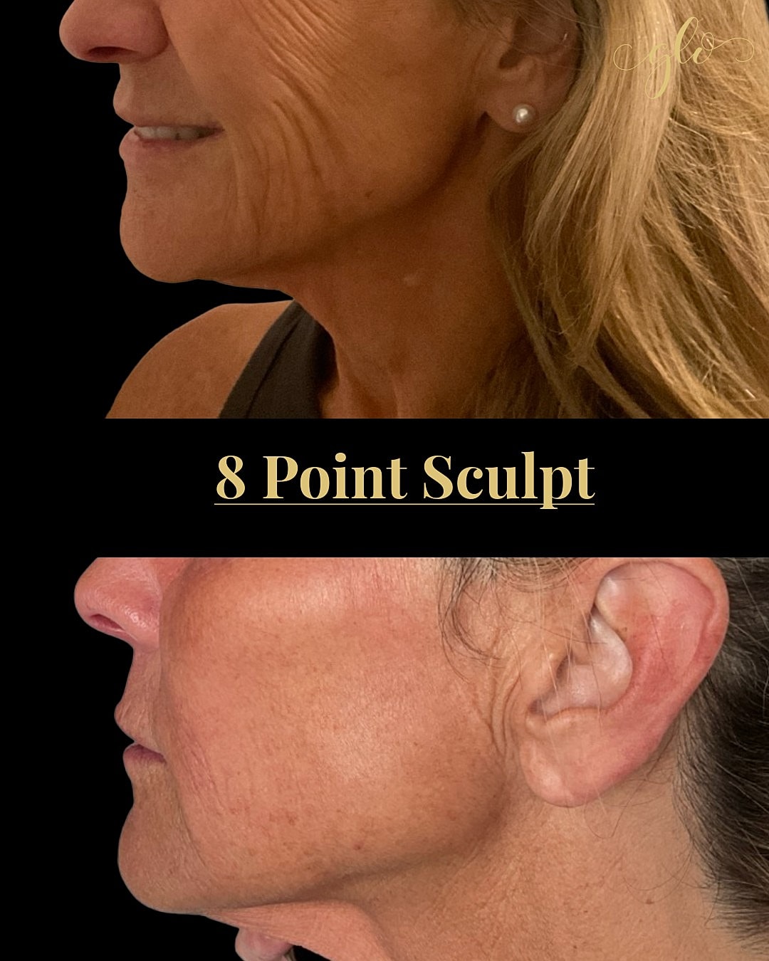 8 Point Sculpt Before & After