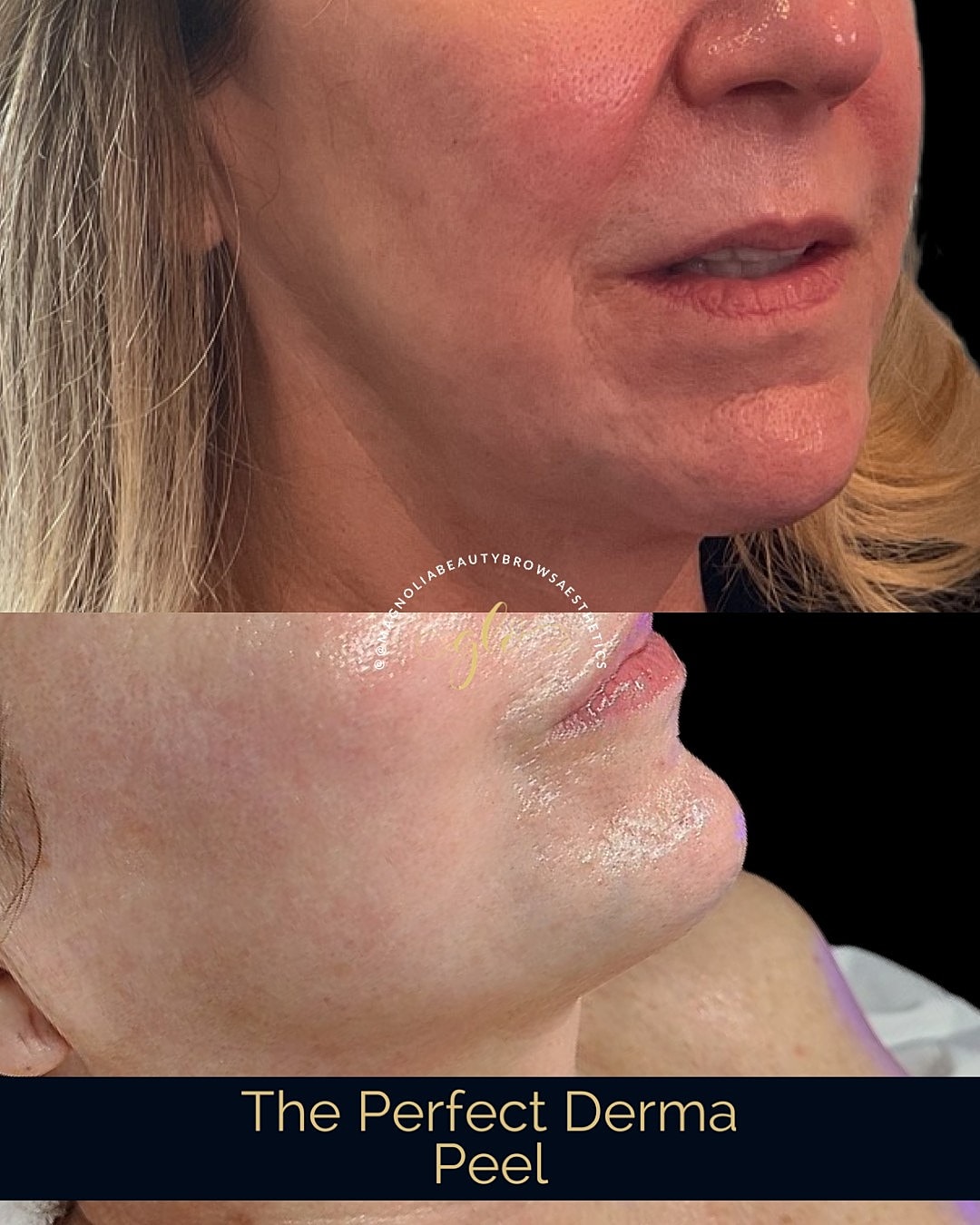 Perfect Derma Peel Before & After