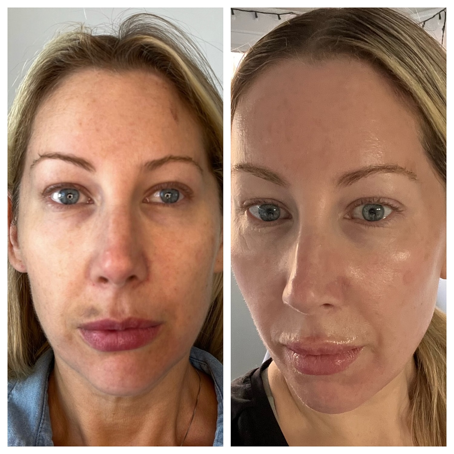CO₂ Laser Skin Resurfacing Before & After