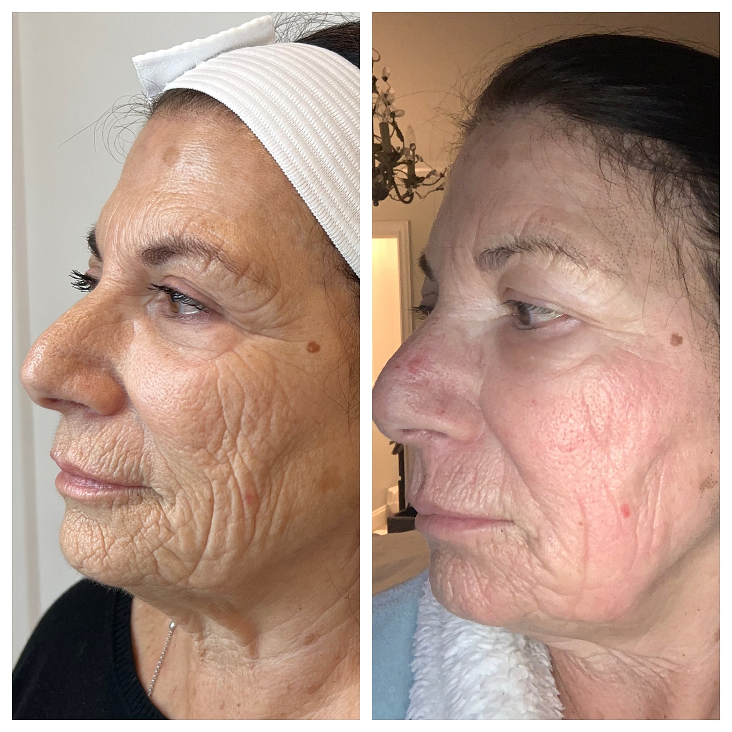 CO₂ Laser Skin Resurfacing Before & After