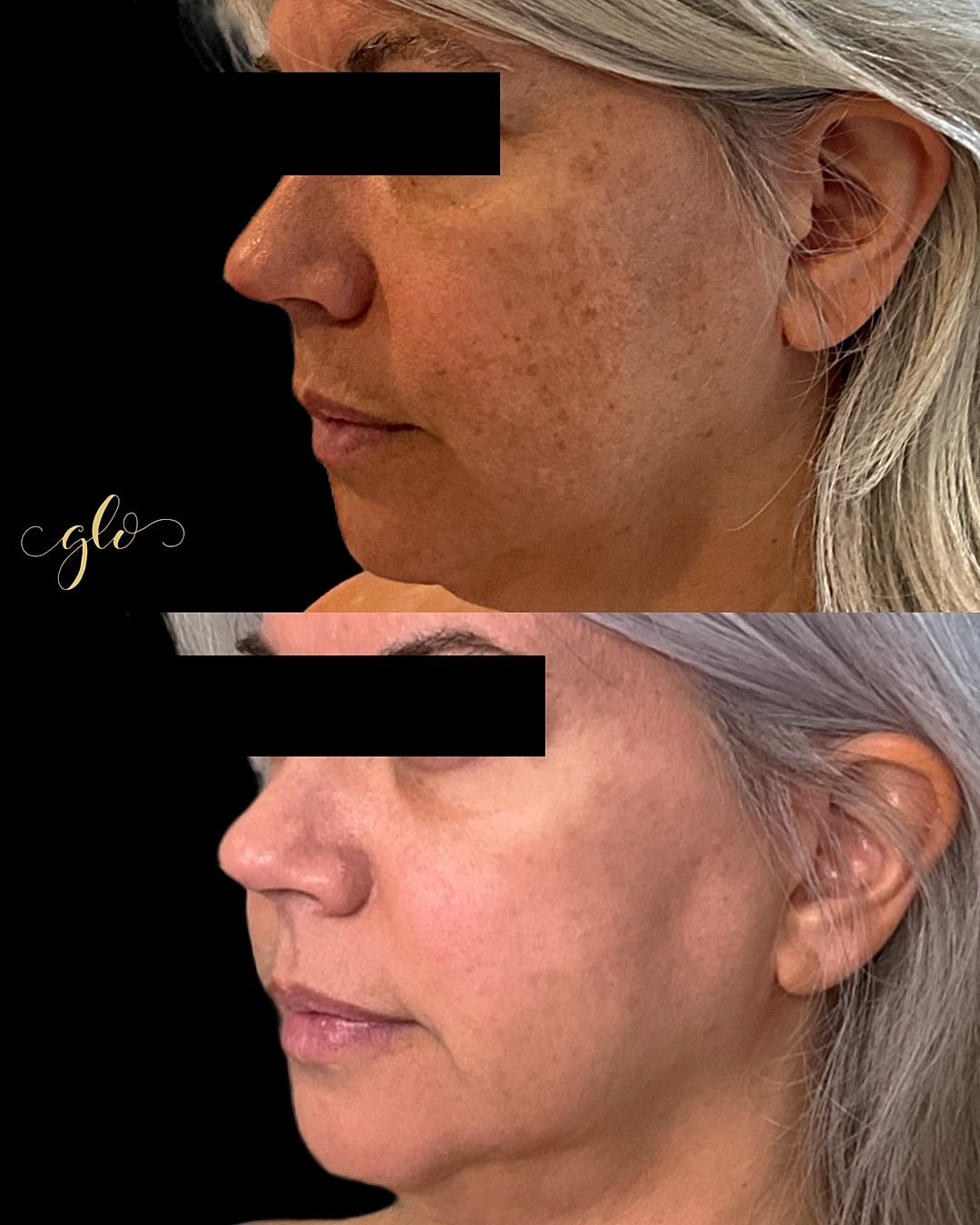 BBL Gallery Before & After