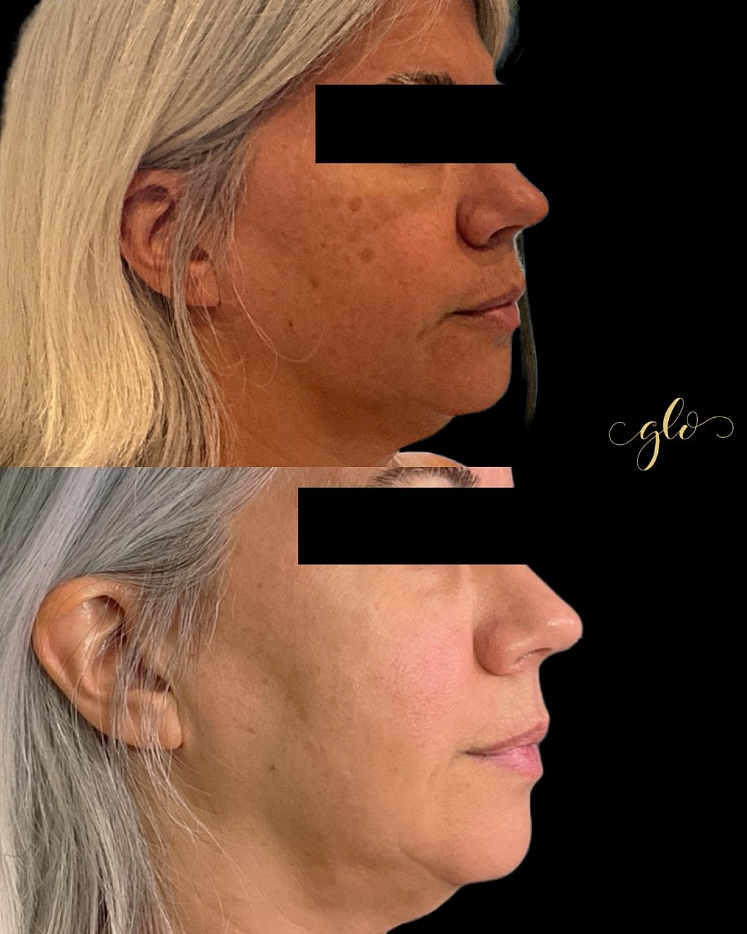 BBL Gallery Before & After