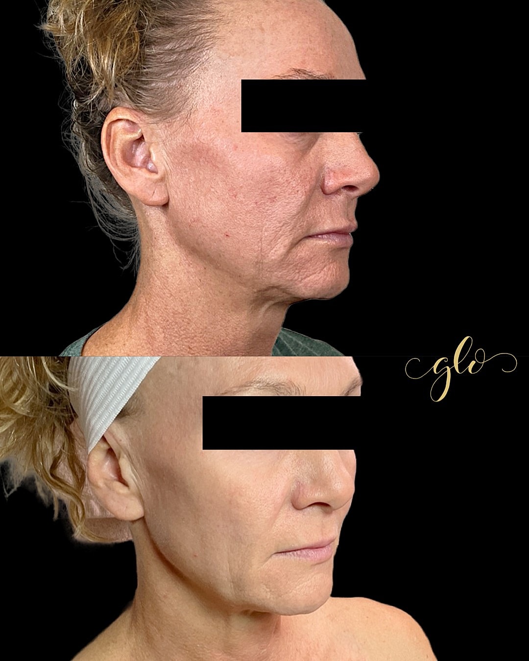 Glo Up Gallery Before & After