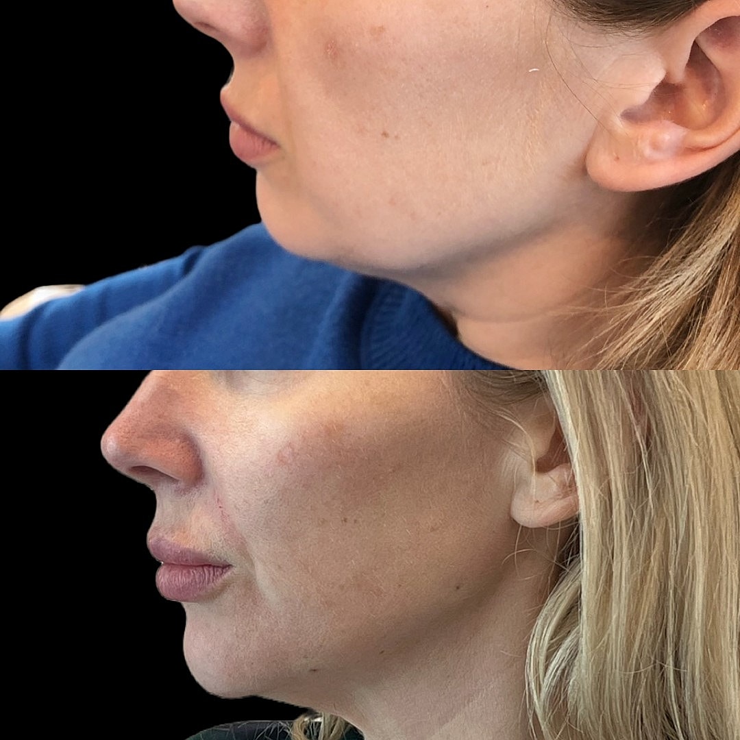 Injectables Treatment