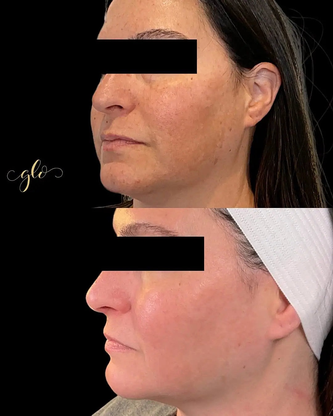 Glo Up Packages at Glo Esthetics in Far Hills, NJ