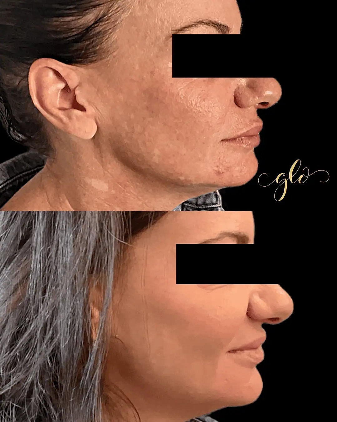 Glo Up Packages at Glo Esthetics in Far Hills, NJ