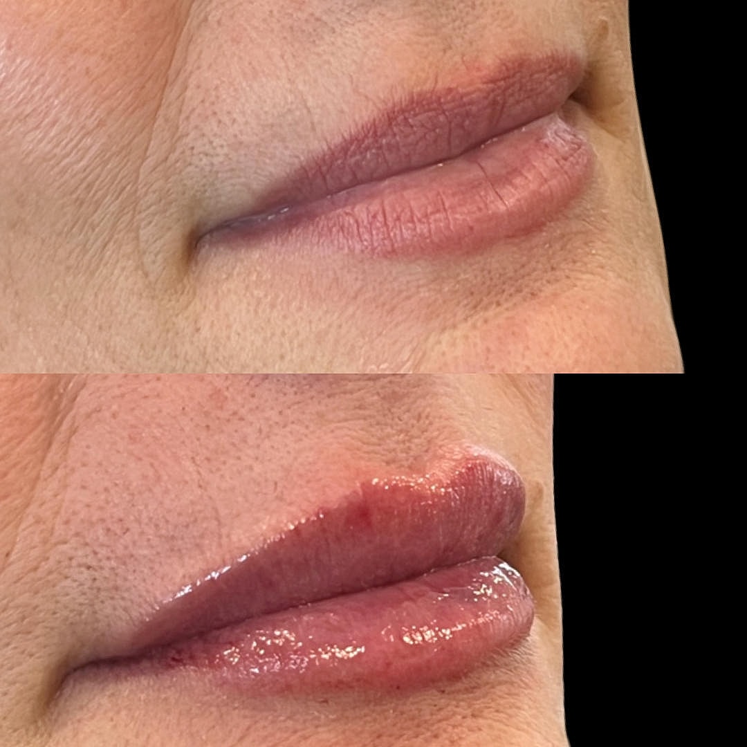 Injectables Treatment