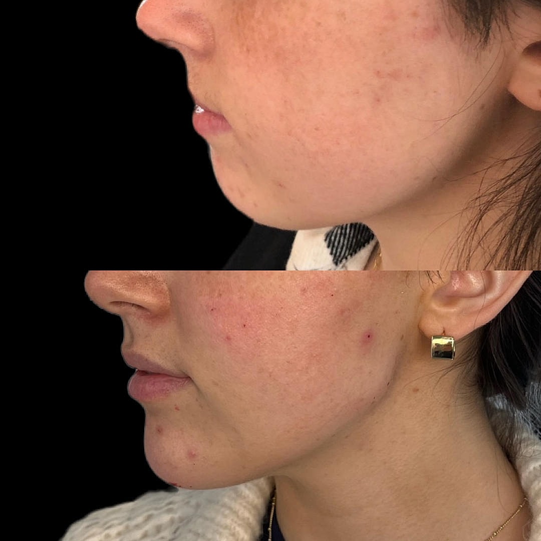 Injectables Treatment